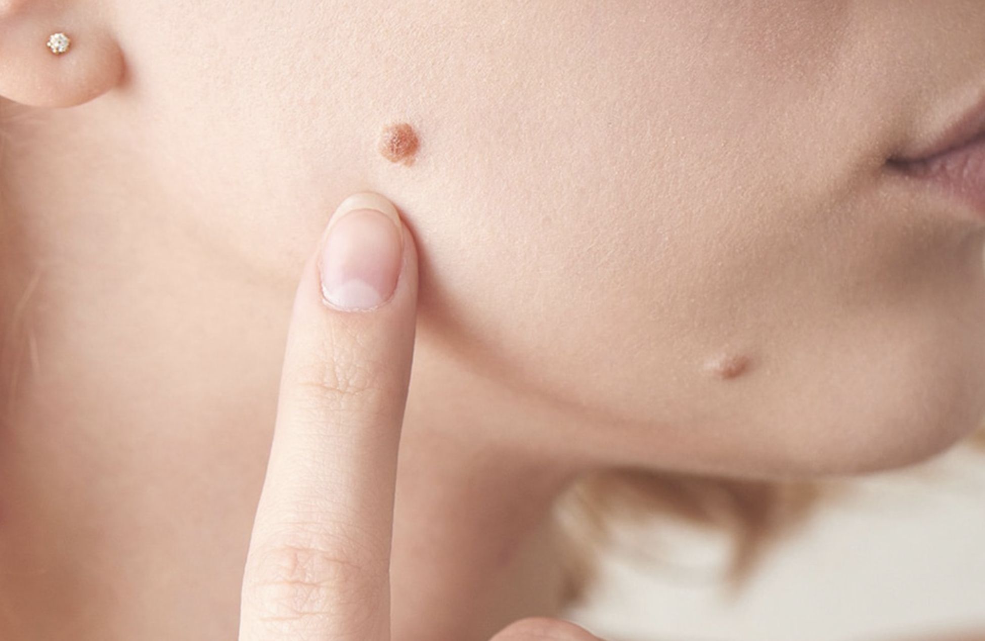 Vorschaubild Video: 10 gängige Ansätze zur Entfernung von Papillomen